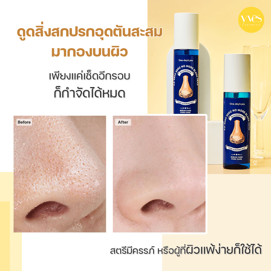 One-day's you P.Z. Ssoc Ssoc No More Blackhead | Yvescosmetic